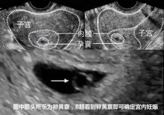 怀孕空孕囊究竟怎么回事？