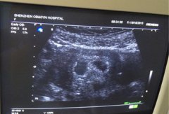龙凤胎孕囊图片如何看呢？准确吗？