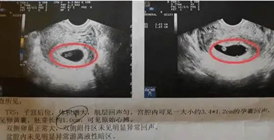 四维彩超如何判断男孩女孩(怀男孩的四维彩超图片)