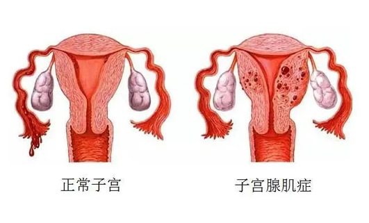 一般子宫腺肌症打了3针后怎么办(子宫腺肌症怎么备孕)