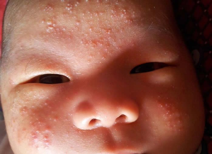 新生儿湿疹跟热疹的区别,这几张图片一对比就知道了