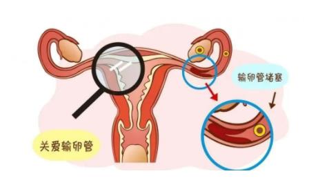 输卵管造影后多久可以要孩子