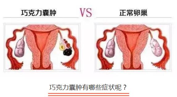 女性巧克力囊肿如何快速自然受孕(女性巧囊怀孕了要注意什么)