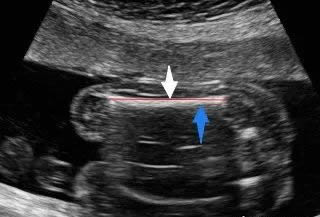 股骨是胎儿的哪个部位图片(胎儿股骨长标准对照)