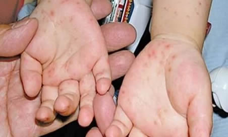 儿童手足口病症状有哪些？认识宝宝手足口病的5大症状