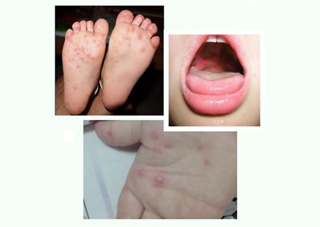 3-6岁小儿手足口病原因及症状(小儿手足口病预防方法)