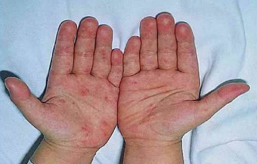 小儿手足口病最早期症状图片(小儿手足口病的注意事项)