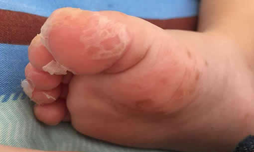 小儿手足口病最早期症状图片(小儿手足口病的注意事项)