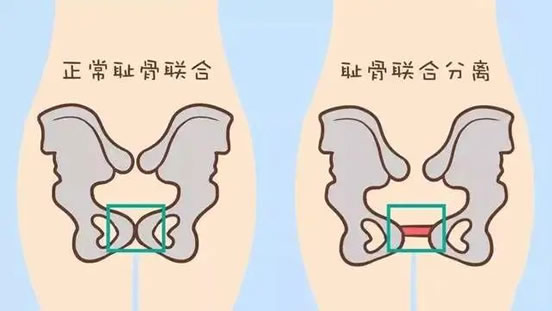 孕妇耻骨位置图在哪个地方(孕妇耻骨疼痛怎么办)