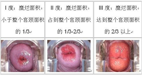 宫颈糜烂一二三度图片(宫颈糜烂各种病变图片对比)