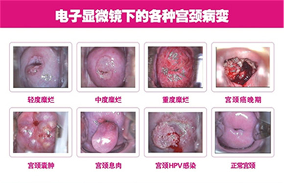 宫颈糜烂一二三度图片(宫颈糜烂各种病变图片对比)