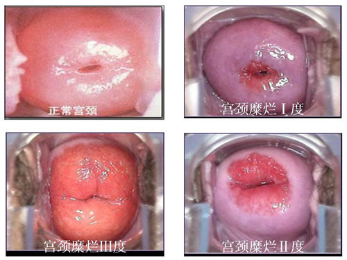 宫颈糜烂一二三度图片(宫颈糜烂各种病变图片对比)