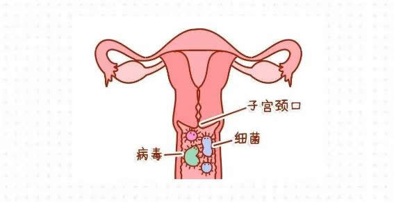 宫颈癌发出的第一个信号,常在月经,3个异常表现