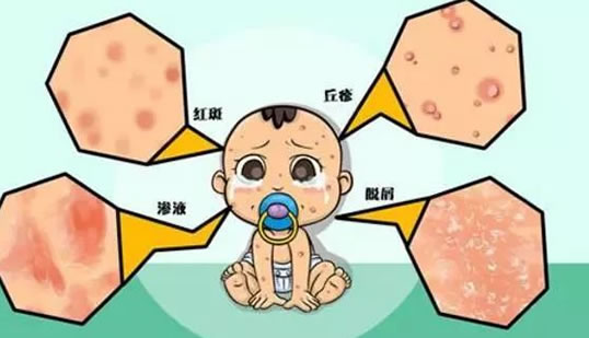 婴儿湿疹病因及症状有哪些(预防,护理方法)