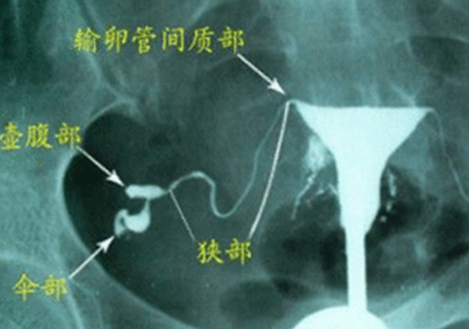 一分钟看输卵管影响正常与否的方法(什么情况需要做输卵管造影检查)