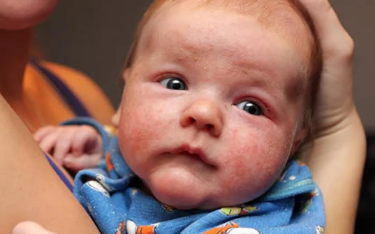婴儿湿疹不能吃的10种食物(哪些孩子容易长期湿疹)