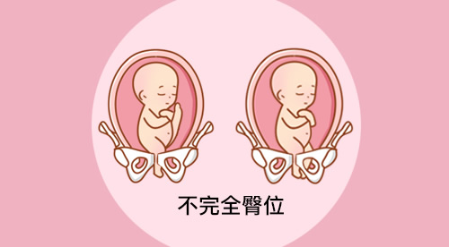 胎儿臀位是什么姿势图(胎儿臀位什么原因造成的)
