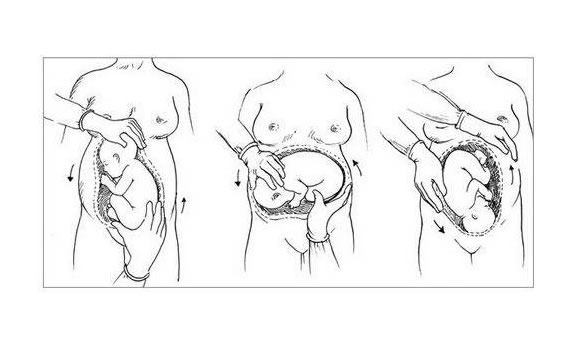 孕晚期胎儿臀位胎动有什么特点