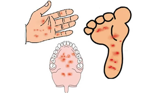 如何辨别手足口疾病(手足口病临床症状体征一览表)