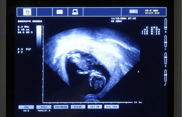 孕期B超孕囊形状看男女(超准)