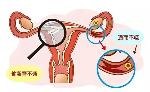 输卵管堵塞通不了怎么办(女性输卵管堵塞会不会宫外孕)