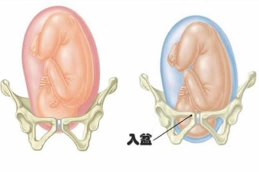 宝宝入盆后的肚型图片(入盆过程图及症状)