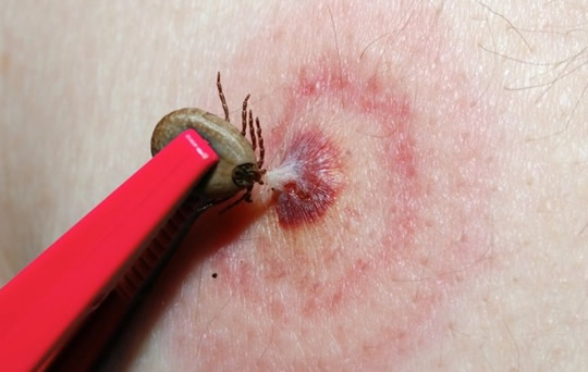 被蜱虫咬了怎么处理 人被蜱虫叮咬后症状图片和伤口图