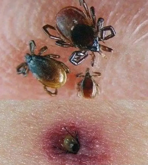 被蜱虫咬了怎么处理 人被蜱虫叮咬后症状图片和伤口图