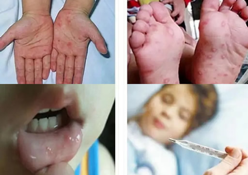 儿童患手足口病初期的症状表现有哪些(图片)