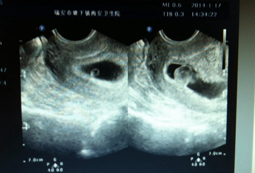 孕8周看孕囊大小预测男女很准吗(B超孕囊大小看男女对照表)