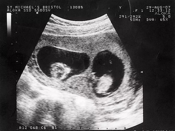 龙凤胎早期孕囊b超图片分享(孕囊一长一圆是不是龙凤胎)