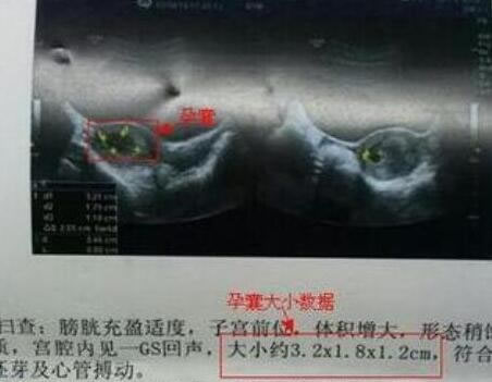 孕囊形状看男女(超准),长条是男宝/圆形是女宝