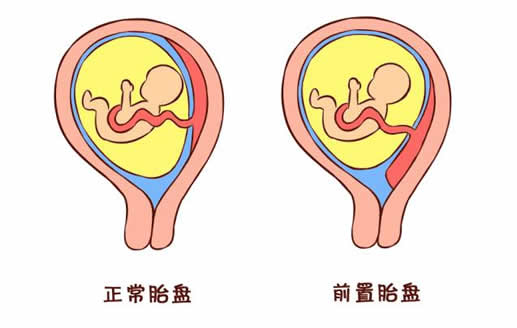 不同孕期的见红各代表什么(孕期出血怎么办)