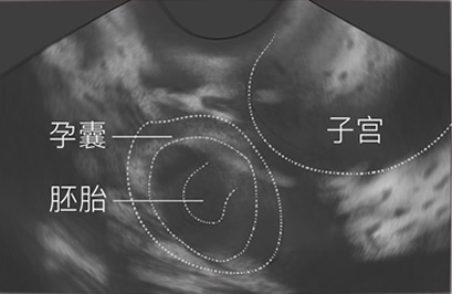 宫外孕b超图片和怀孕b超图片(宫外孕和宫内孕的区别)