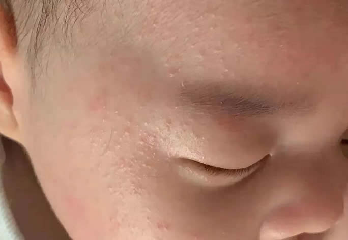 宝宝身上的热痱子和湿疹的区别 婴儿湿疹和热疹的区别图片