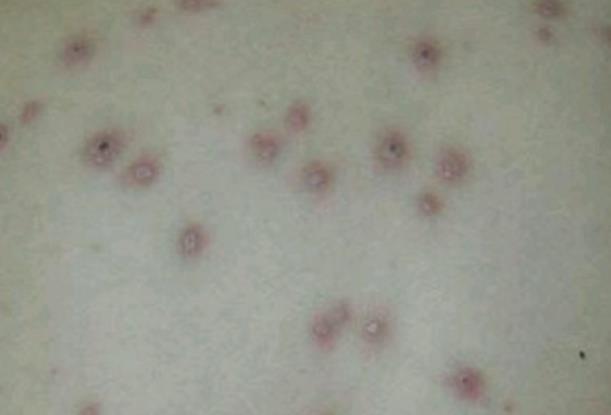 水痘初期症状图片(的传播路径和多久可以痊愈)