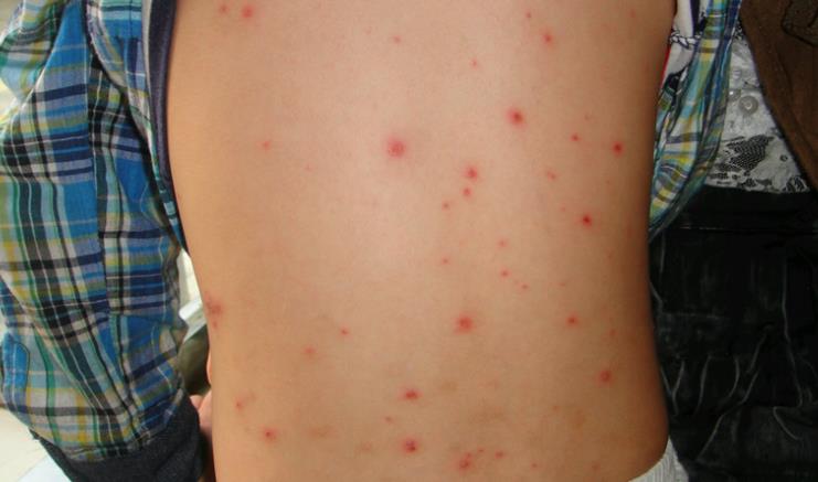 水痘初期症状图片(附传播路径和多久可以痊愈)
