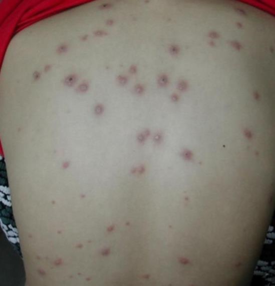 水痘初期症状图片(附传播路径和多久可以痊愈)