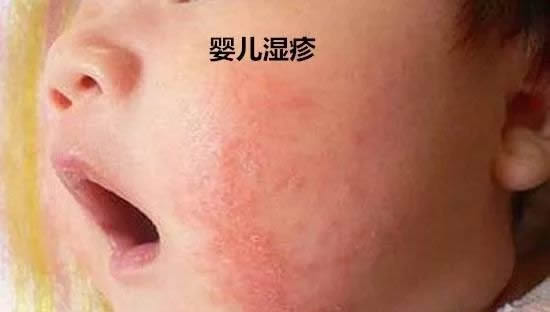 宝宝身上的热痱子和湿疹的区别 婴儿湿疹和热疹的区别图片