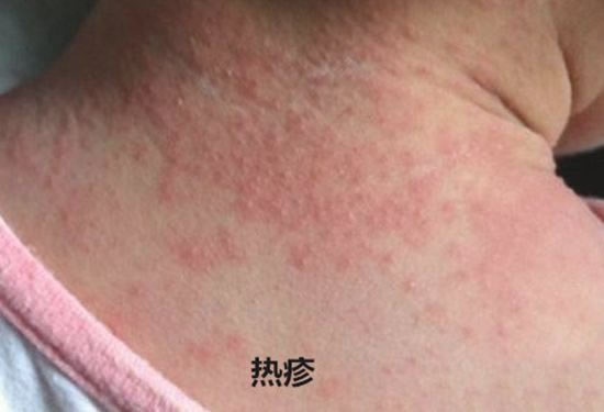 宝宝身上的热痱子和湿疹的区别 婴儿湿疹和热疹的区别图片