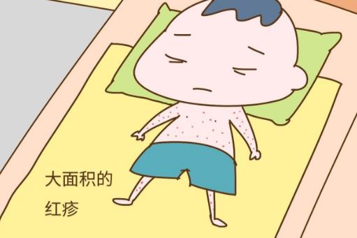 幼儿急疹出疹子后禁忌(一般多大宝宝会有)