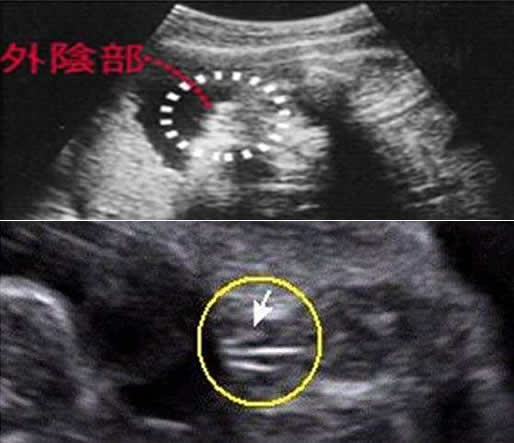 四维彩超怎么看胎儿是男是女呢(已生男女宝四维图)