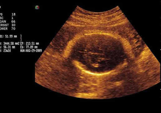 怀孕孕囊圆的是男是女(孕囊看男女准吗)
