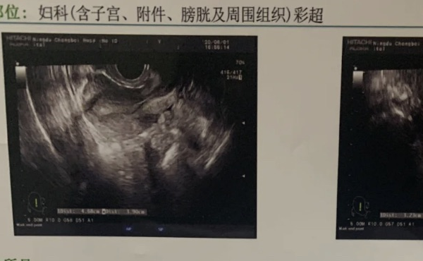 内膜3.3mm单层可不可以正常怀孕？