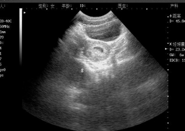 孕早期胚芽怎么看男女(准不准)