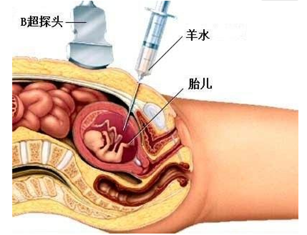 如何进行羊水穿刺 注意事项和应用价值