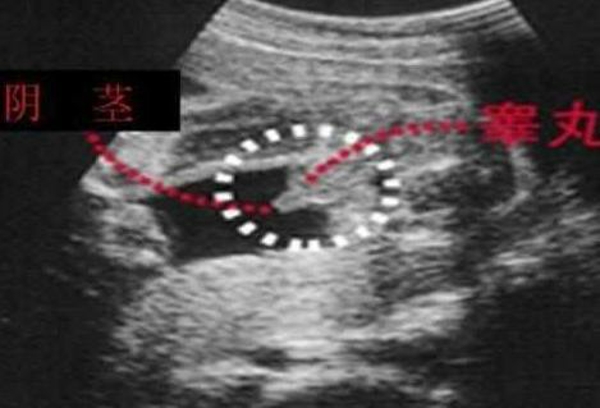 二维彩超判断性别的诀窍(通过二维彩超看男女准不准)