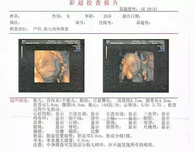 四维彩超单看男女小窍门(5个方法)