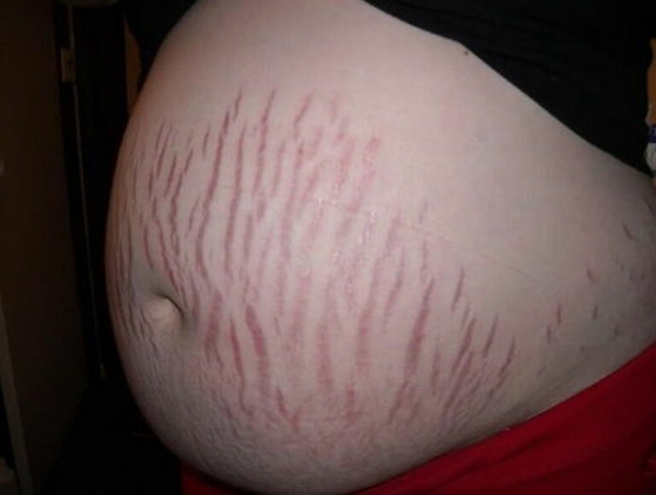 孕妇肚子妊娠纹如何看男女(妊娠纹判断生男生女简易图)