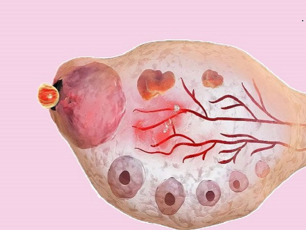 不是多囊卵泡多的原因有哪些(会不会排卵)